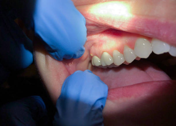 Best Knocked-Out Tooth Emergency  in Winooski, VT