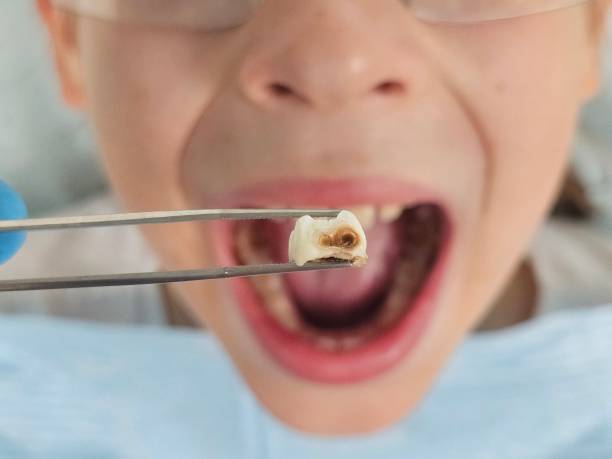 Best Cracked Tooth Emergency Dentist  in Winooski, VT